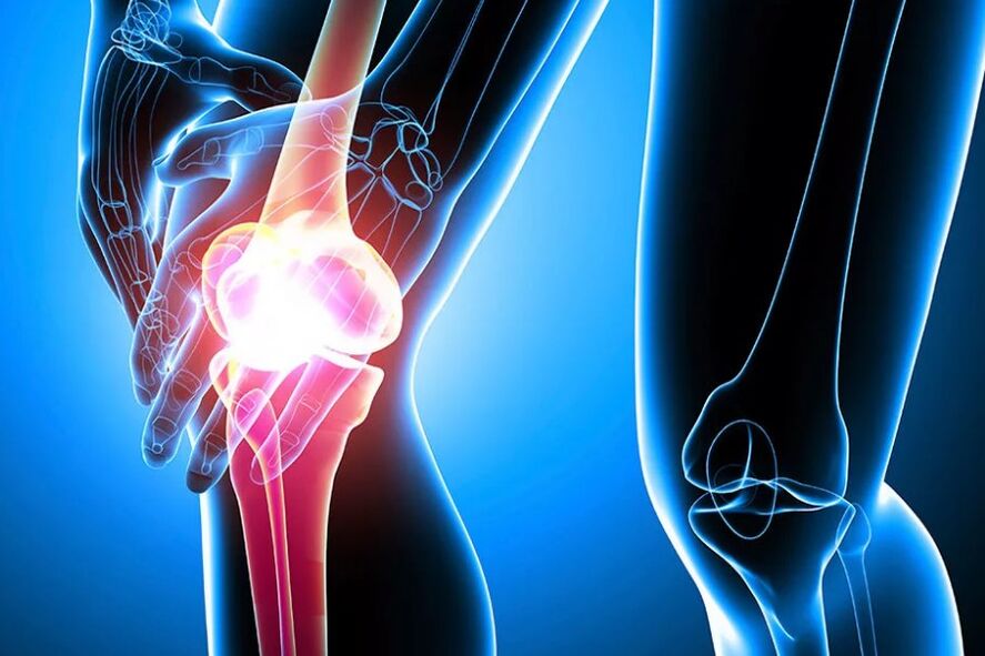 arthrosis នៃជង្គង់