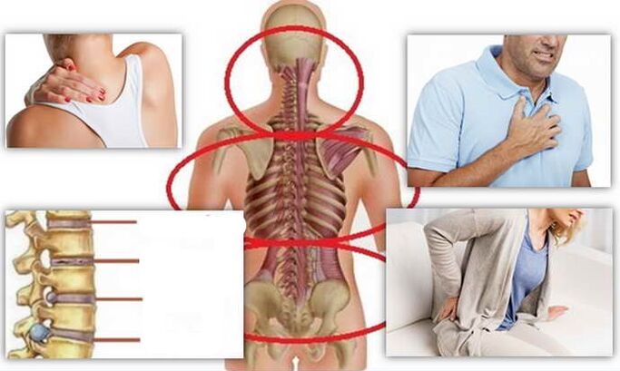 កន្លែងនៃជំងឺសម្រាប់ជំងឺ osteochondrosis