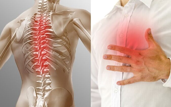 osteochondrosis thoracic ត្រូវបានបង្ហាញដោយការឈឺចាប់និងអារម្មណ៍នៃការតឹងនៅក្នុងទ្រូង